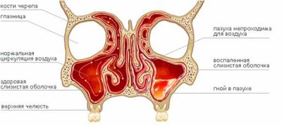 Особенности протекания и методы терапии аллергического вазомоторного ринита Особенности протекания и методы терапии аллергического вазомоторного ринита