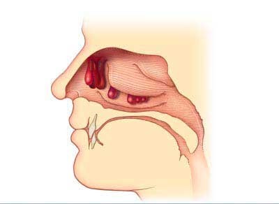 Особенности протекания и методы терапии аллергического вазомоторного ринита Особенности протекания и методы терапии аллергического вазомоторного ринита