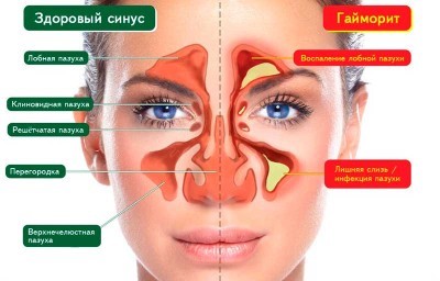 Особенности протекания и методы терапии аллергического вазомоторного ринита Особенности протекания и методы терапии аллергического вазомоторного ринита
