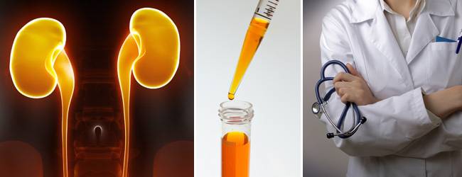 Описание анализа мочи на микроальбуминарию Описание анализа мочи на микроальбуминарию