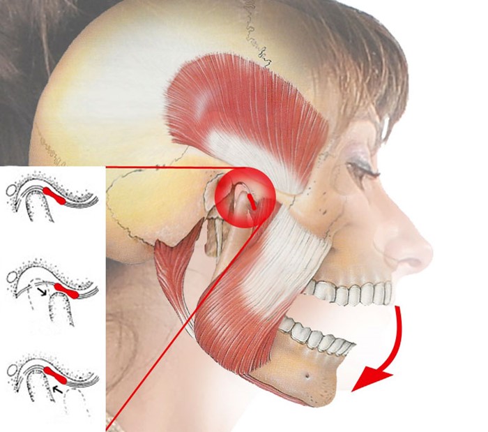 Артроз височно-нижнечелюстного сустава: симптомы и лечение ВНСЧ Артроз височно-нижнечелюстного сустава: симптомы и лечение ВНСЧ