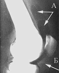 Гонартроз википедия Гонартроз википедия