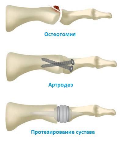 Как распознать и лечить артроз пальцев рук Как распознать и лечить артроз пальцев рук