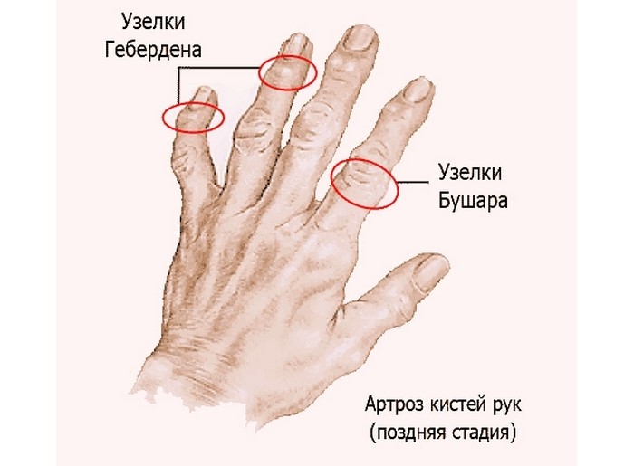 Как распознать и лечить артроз пальцев рук Как распознать и лечить артроз пальцев рук