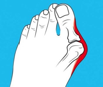 Как распознать и лечить артроз пальцев рук Как распознать и лечить артроз пальцев рук