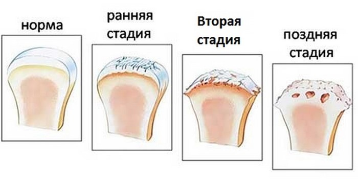 Как распознать и лечить артроз пальцев рук Как распознать и лечить артроз пальцев рук