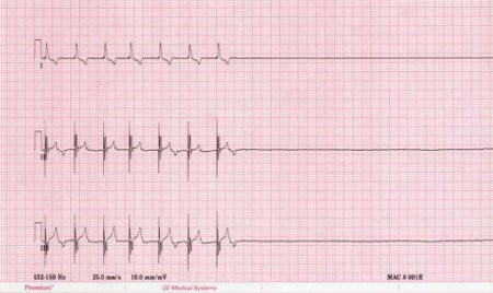 Остановка сердца, асистолия: первая помощь, причины, лечение Остановка сердца, асистолия: первая помощь, причины, лечение