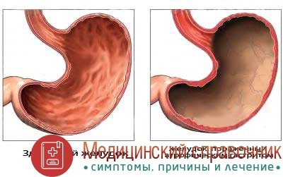 Профилактика и лечение атрофического очагового гастрита Профилактика и лечение атрофического очагового гастрита