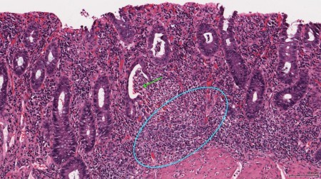 Чем лечить атрофический колит кишечника? Чем лечить атрофический колит кишечника?