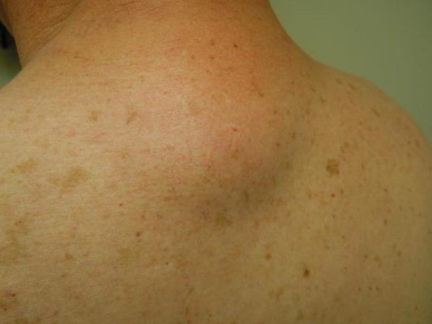 Жировик на спине покраснел и болит Жировик на спине покраснел и болит