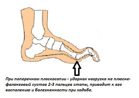 Болит стопа снизу возле пальцев: почему болят подушечки, чем лечить ступню Болит стопа снизу возле пальцев: почему болят подушечки, чем лечить ступню