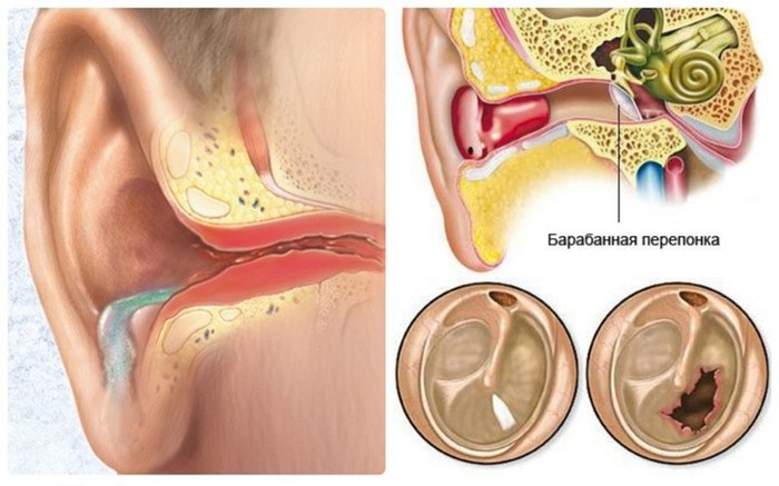 Лечение отита борной кислотой Лечение отита борной кислотой