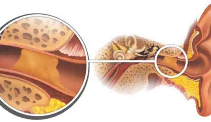 Лечение отита борной кислотой Лечение отита борной кислотой