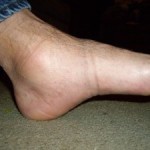 Бурсит голеностопного сустава: лечение, симптомы, фото стопы Бурсит голеностопного сустава: лечение, симптомы, фото стопы