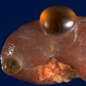 Чем опасен разрыв кисты почки? Чем опасен разрыв кисты почки?