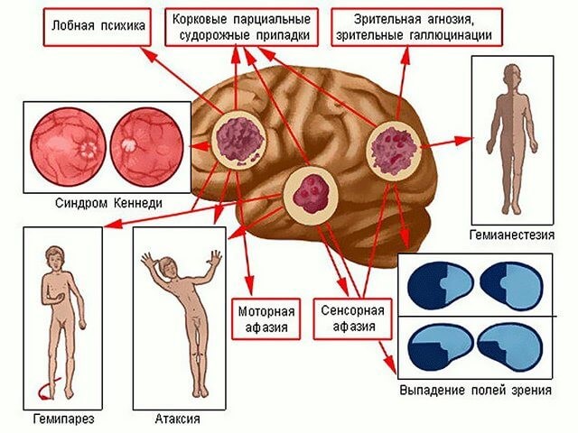 Черепно-мозговая травма (ЧМТ): симптомы, лечение, последствия Черепно-мозговая травма (ЧМТ): симптомы, лечение, последствия