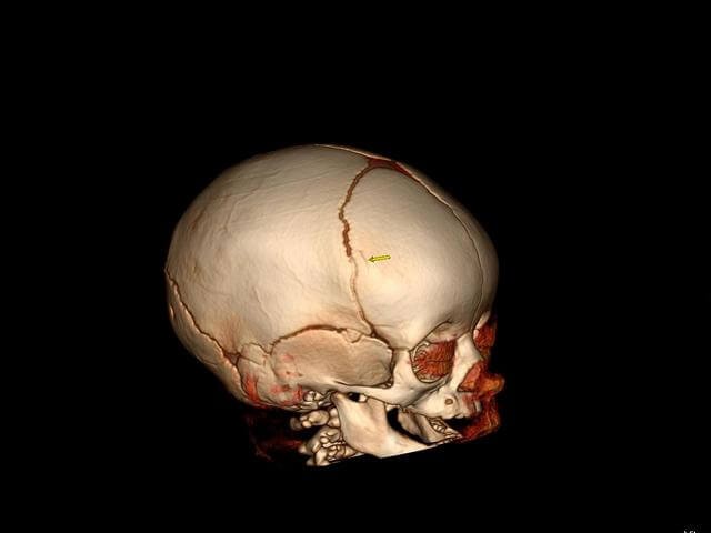 Черепно-мозговая травма (ЧМТ): симптомы, лечение, последствия Черепно-мозговая травма (ЧМТ): симптомы, лечение, последствия