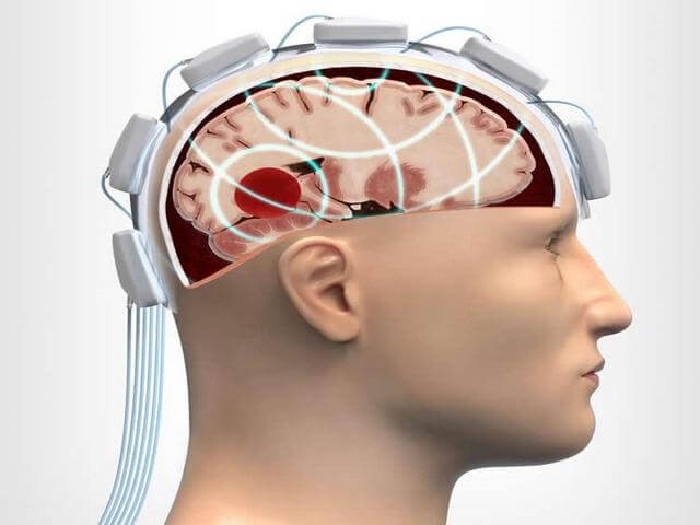 Черепно-мозговая травма (ЧМТ): симптомы, лечение, последствия Черепно-мозговая травма (ЧМТ): симптомы, лечение, последствия