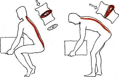 Что делать, когда сорвал спину: способы лечения Что делать, когда сорвал спину: способы лечения