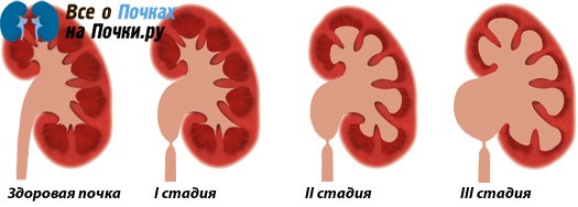 Гипотония лоханки почки: признаки, диагностика, лечение Гипотония лоханки почки: признаки, диагностика, лечение