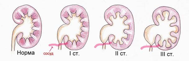 Гипотония лоханки почки: признаки, диагностика, лечение Гипотония лоханки почки: признаки, диагностика, лечение