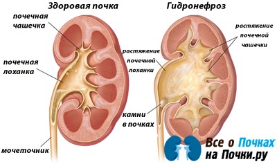 Гипотония лоханки почки: признаки, диагностика, лечение Гипотония лоханки почки: признаки, диагностика, лечение