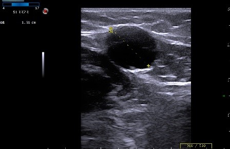 Особенности тромбофлебита глубоких вен нижних конечностей Особенности тромбофлебита глубоких вен нижних конечностей