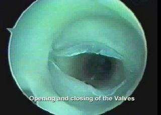 Особенности тромбофлебита глубоких вен нижних конечностей Особенности тромбофлебита глубоких вен нижних конечностей