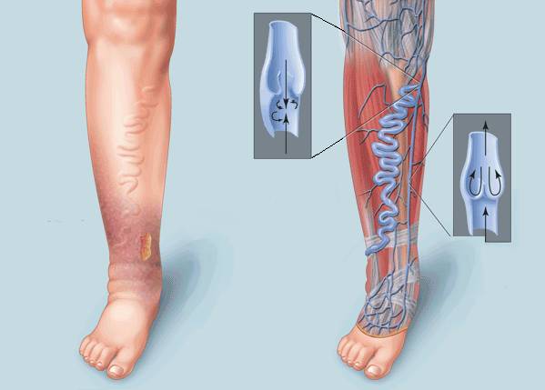 Особенности тромбофлебита глубоких вен нижних конечностей Особенности тромбофлебита глубоких вен нижних конечностей