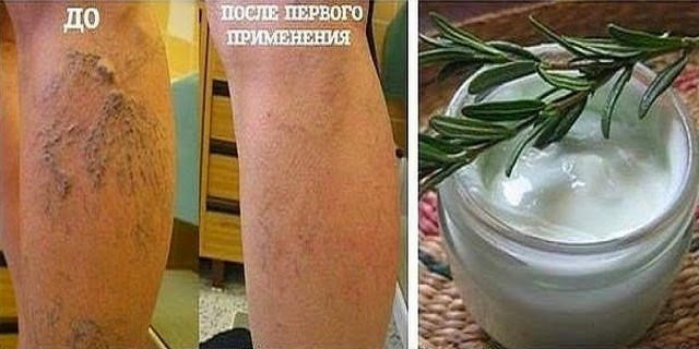 Особенности тромбофлебита глубоких вен нижних конечностей Особенности тромбофлебита глубоких вен нижних конечностей