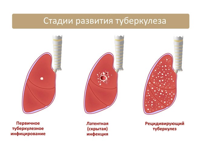 Что может выявить флюорография? Что может выявить флюорография?