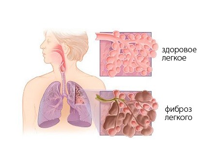 Что может выявить флюорография? Что может выявить флюорография?