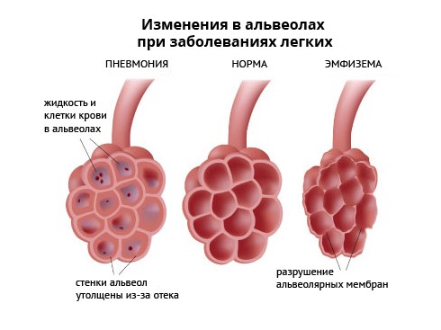 Что может выявить флюорография? Что может выявить флюорография?