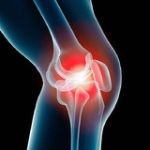 Что такое артроз: причины возникновения, методы лечения и последствия болезни Что такое артроз: причины возникновения, методы лечения и последствия болезни