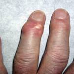 Что такое подагрический тофус: как удалить (убрать), фото ушной раковины Что такое подагрический тофус: как удалить (убрать), фото ушной раковины