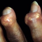 Что такое подагрический тофус: как удалить (убрать), фото ушной раковины Что такое подагрический тофус: как удалить (убрать), фото ушной раковины