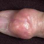 Что такое подагрический тофус: как удалить (убрать), фото ушной раковины Что такое подагрический тофус: как удалить (убрать), фото ушной раковины