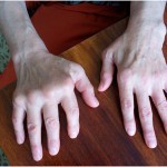 Что такое подагрический тофус: как удалить (убрать), фото ушной раковины Что такое подагрический тофус: как удалить (убрать), фото ушной раковины