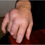 Что такое подагрический тофус: как удалить (убрать), фото ушной раковины Что такое подагрический тофус: как удалить (убрать), фото ушной раковины