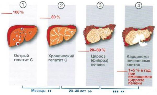 Какие гарантии что после лечения гепатита С не будет рецидива? Какие гарантии что после лечения гепатита С не будет рецидива?