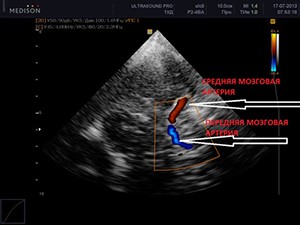 О чем говорит УЗИ сосудов головы и шеи? О чем говорит УЗИ сосудов головы и шеи?