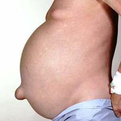 Сколько живут при циррозе печени различной степени (продолжительность) Сколько живут при циррозе печени различной степени (продолжительность)