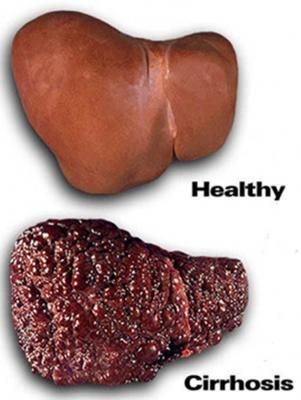 Сколько живут при циррозе печени различной степени (продолжительность) Сколько живут при циррозе печени различной степени (продолжительность)