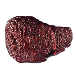 Сколько живут при циррозе печени различной степени (продолжительность) Сколько живут при циррозе печени различной степени (продолжительность)