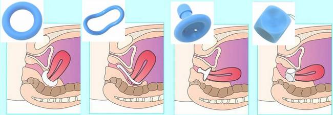 Опущение мочевого пузыря - как лечить патологию? Опущение мочевого пузыря - как лечить патологию?