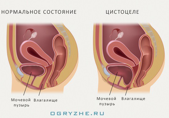 Опущение мочевого пузыря - как лечить патологию? Опущение мочевого пузыря - как лечить патологию?