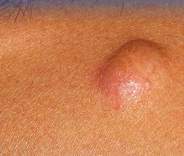 Деформация желчного пузыря Деформация желчного пузыря