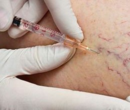 Деформация желчного пузыря Деформация желчного пузыря