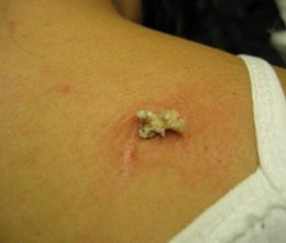 Деформация желчного пузыря Деформация желчного пузыря