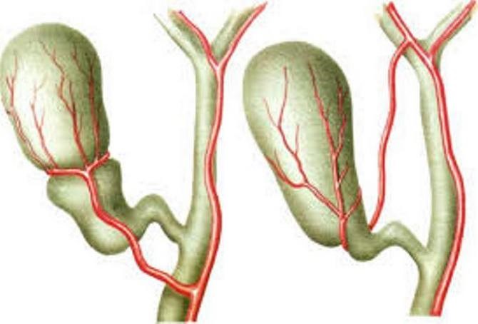 Диета при загибе желчного пузыря Диета при загибе желчного пузыря